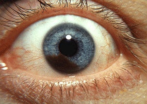 Melanoma a l'iris | Wikimedia Commons