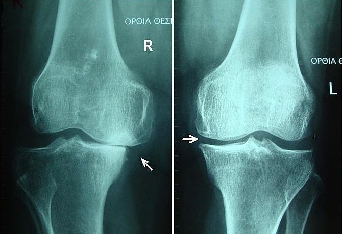 Artritis del genoll | Wikimedia Commons