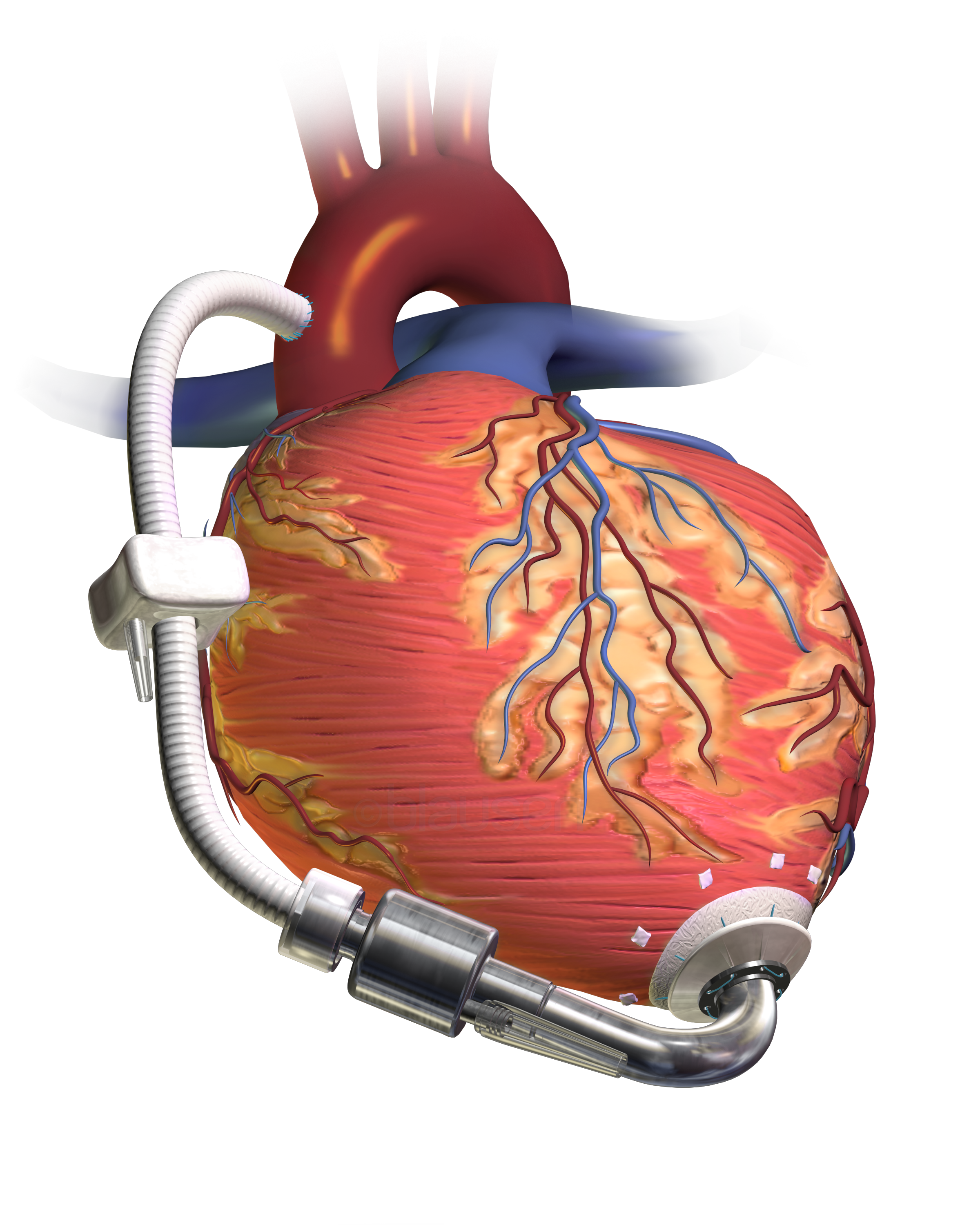 Un dispositiu LVAD | Wikimedia Commons