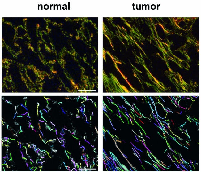 Los investigadores han desarrollado y validado una nueva técnica para analizar cuantitativamente las fibras de colágeno en muestras de tejidos de pacientes con cáncer de pulmón de células no pequeñas | UB
