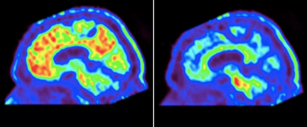 El donanemab redueix clarament l'acumulació de proteïna beta amiloide al cervell, frenant els símptomes de l'Alzheimer | Eli Lilly