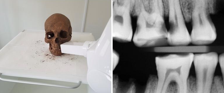 Los restos han sido estudiadas con tecnologías modernas | Universidad de Gotemburgo