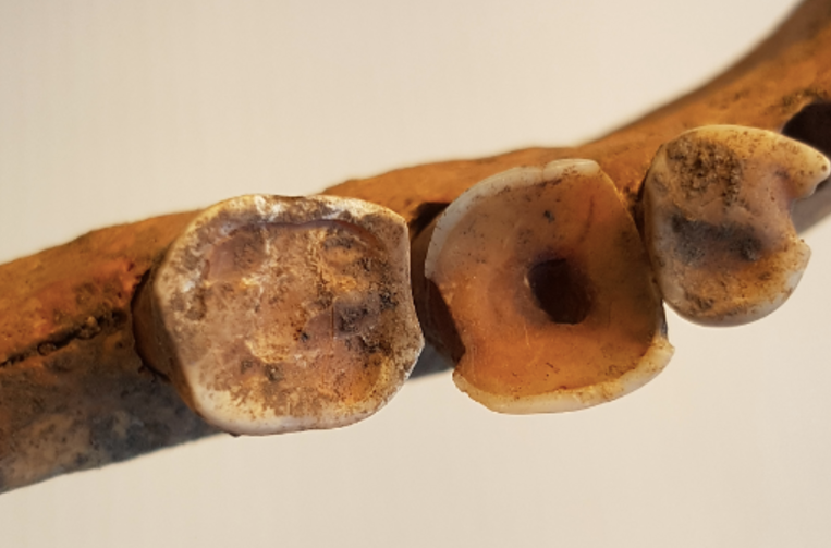 Los tratamientos empleados por los vikingos para tener cura de los dientes eran sorprendentemente complejos | Universidad de Gotemburgo