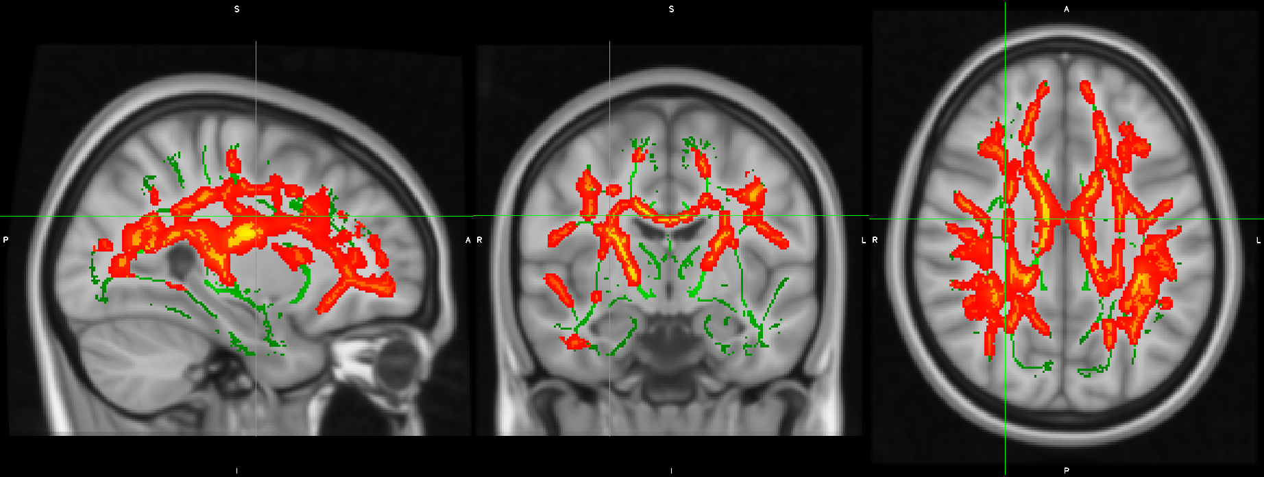 Imatges de ressonància magnètica cerebral que mostren les àrees de la matèria blanca on els canvis en inflamació cerebral associats al tractament antipsicòtic varien segons el consum previ de cànnabis | Institut de Recerca de l'Hospital del Mar